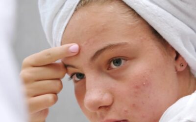 Bye-bye Pickel! Wie Teenager mit Hormonen & Akne umgehen – und wie Caps beauty&hair von innen helfen