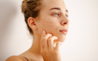 SOS-Pickel-Gel von RINGANA: Natürlich, punktuell & wirksam gegen Hautunreinheiten